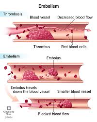 <p>What is an embolus?</p>