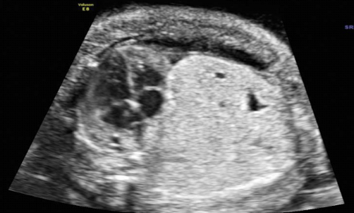 <p>mainly solid lesion with tiny cysts (< 0.5cm)</p><ul><li><p>hyperechoic mass without detectable cysts </p></li></ul><p></p>
