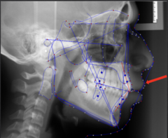<p>which anatomical landmark:</p><p>- Most anterior point on the curve of the upper lip</p>