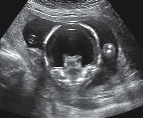 <p>5. What sonographic finding is present in Figure 24-33?</p><p>Figure 24-33</p><p>a. Absent cranial vault</p><p>b. Choroid plexus cysts</p><p>c. Colpocephaly</p><p>d. Fused thalami</p>