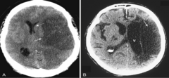 <p>better circumscribed lesion w mass effect that peaks at 3-5 days and usually disappears by 2-4 weeks </p><p>TLDR: abnormality peaks w/in 1st week, and resolves w/in a few weeks</p>