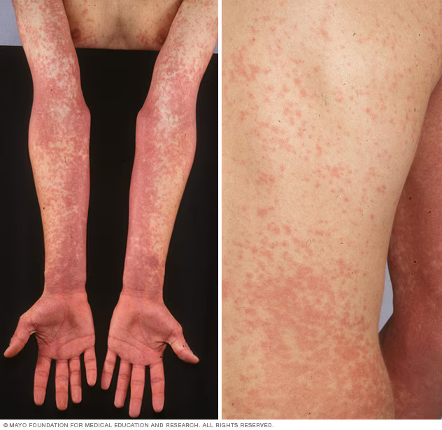 <p>A distinctive red, sandpaper-like rash, a high fever, and a very sore throat</p>