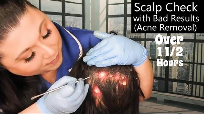 <p>I Pop pimples in my scalp</p>