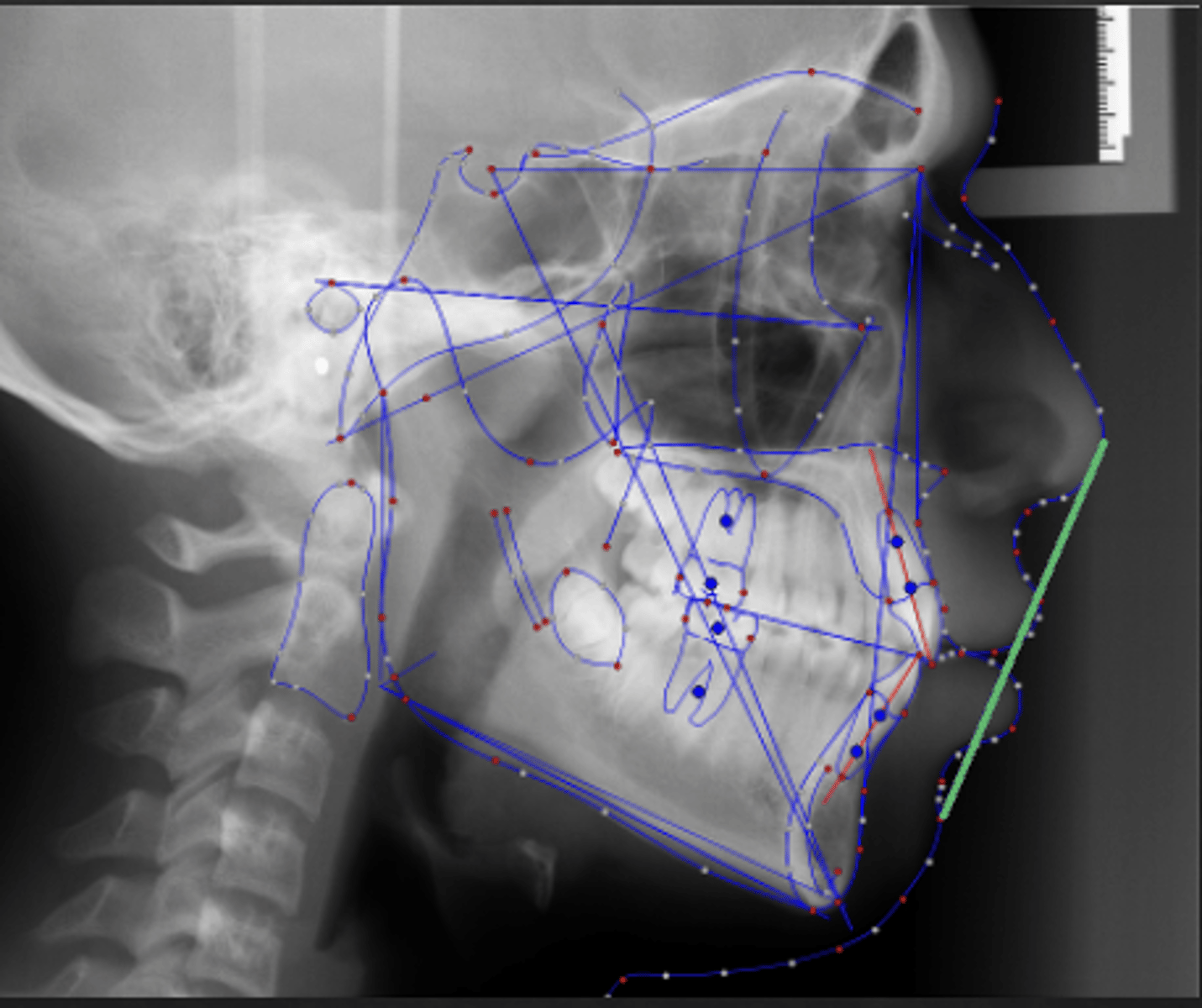 <p>which reference plane:</p><p>- Tip of Nose to Soft Tissue Pogonion</p><p>- Lip protrusion reference plane</p><p>- Heavily affected by nose and chin size</p>