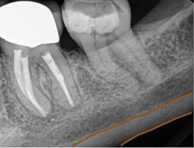 <p>What is this anatomical image you should see in a mandibular molar radiograph?</p>