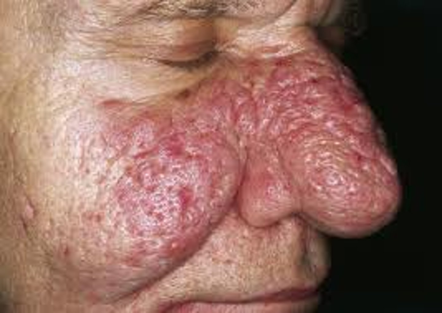 <p>- erythema of cheeks with telangiectasias, flushing, rhinophyma, papules/pustules</p><p>- found on the face, neck, chest, ocular</p><p>- neurovascular inflammation</p>