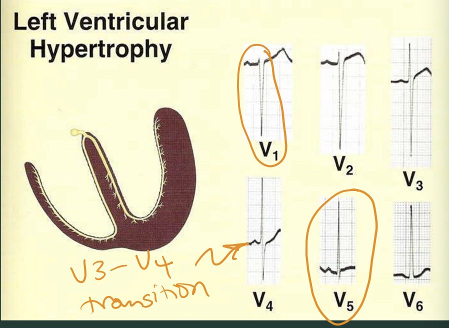 <p>normal chest lead progression, but with abnormally large amplitudes</p>