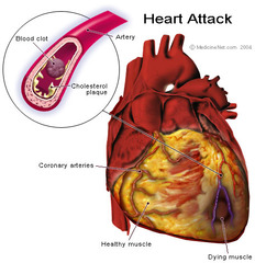 <p>Heart Attack- blood flow blockage, could cause cardiac arrest</p><p>Sudden Cardiac Arrest- rhythm (electrical) problem, a common cause of SCA is a person having a massive heart attack but there are many other causes of SCA.</p>
