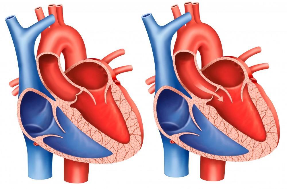 <p>Aortic valve leaflets do not close properly during diastole…</p><p>i.) The annulus (valve ring) may be dilated, loose, or deformed</p><p>ii.) Blood flows backward from aorta into l ventricle during diastole</p><p>iii.) L ventricle dilates to accommodate greater blood volume → eventually hypertrophies</p>