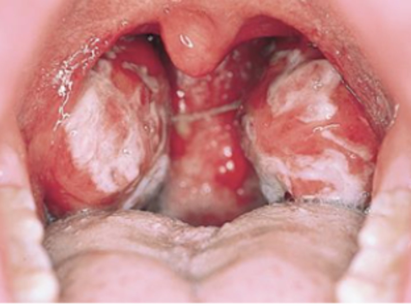 <p>This red throat has thick white exudates on the tonsils.&nbsp;</p><p>This, together with fever and enlarged cervical nodes, increases the probability of group A streptococcal infection or infectious mononucleosis.&nbsp;</p><p>Anterior cervical lymph nodes are usually enlarged in the former, posterior nodes in the latter.</p>