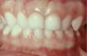 <p>primary dentition with no primate spacing </p>
