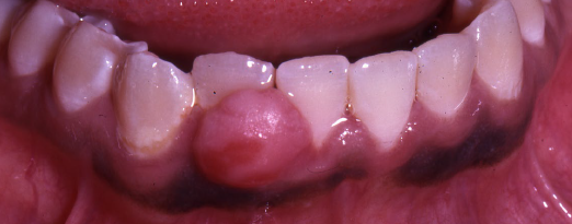 <ul><li><p>not confused with “peripheral odontogenic fibroma”</p></li><li><p>relatively common reactive lesion,<strong> probably arising from periodontal ligament</strong></p></li><li><p>unrelated to the central ossifying fibroma</p></li><li><p><strong>exclusively on the gingiva</strong></p></li><li><p><strong>maxilla> </strong>mandible</p></li><li><p>frequently ulcerated</p></li></ul><p></p>