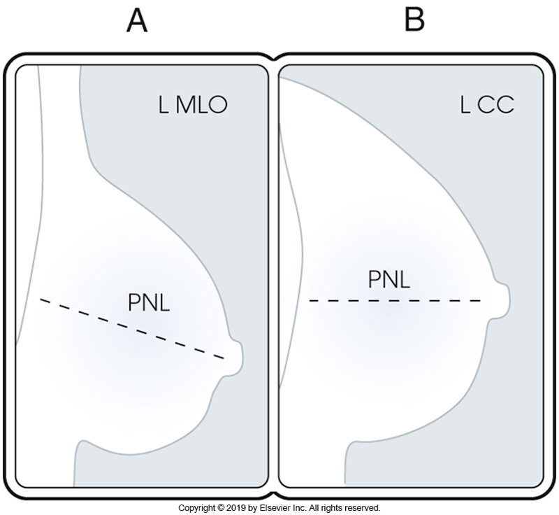 <p>an imaginary line drawn from the nipple to the edge of the image, chest wall or pectoralis muscle (whichever comes first) </p><p>used to measure the depth of the breast in both CC and MLO images </p><p>determines whether sufficient breast tissue was imagied </p><p>(compared between both CC and ML images and should be within 1cm of each projection </p><p><strong>should demonstrate the inferior aspect of the pectoralis muscle extending to or below the line for the MLO </strong></p><p><strong>images will inclyde the pectroalis muscle 30% of the time for CC</strong></p>