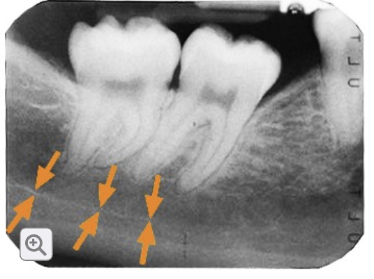 <p>what is the mandibular canal?</p>