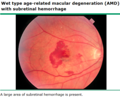 <p>- Abnormal new blood vessel (choroidal neovascularization) growth occurs beneath the retina</p><p>- Leaking/bleeding from these vessels cause blurring or sudden vision loss</p>