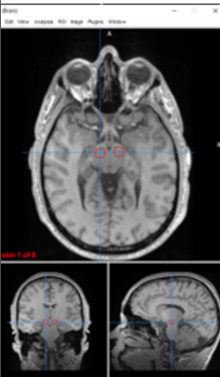 <p>substantia nigra</p>
