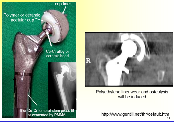 <p>usually very successful but can have complications because of the polymer material wearing out</p>