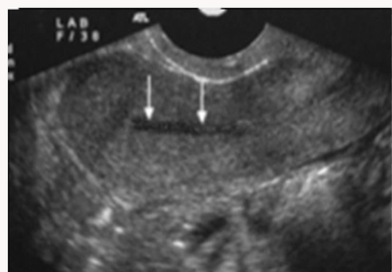 <p>Identify the endometrial phase</p>