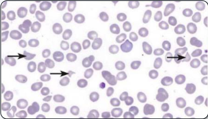 <p>What abnormal RBC shape is indicated? </p>