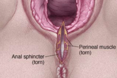 <p>Continues through anal sphincter muscle torn</p>