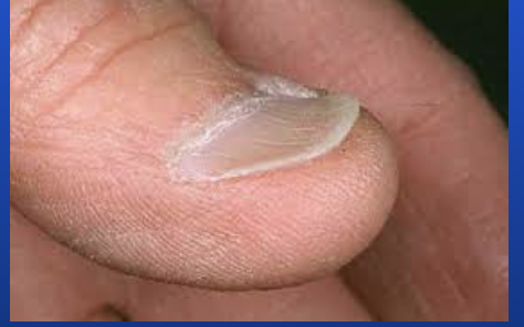 <p>Nails with central depression and elevated edges; associated with iron deficiency anemia.</p>