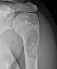 <p>What is this?</p><p>- 3-14 yo, male</p><p>- No pain until trauma</p><p>- Metaphyseal - Humerus/ proximal femur</p>