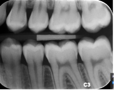 <p><span style="font-family: Calibri, sans-serif;"><strong>Vurder den optiske densitet på denne fosforplade.</strong></span></p>