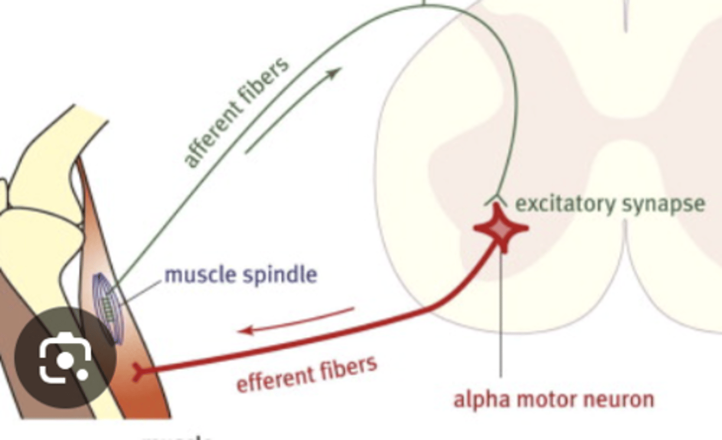 <p>-Damage to the alpha motor neuron at or distal to the anterior horn</p><p>i.e., Damage to cell body in the anterior horn (CNS), ventral root before joining spinal nerve or even after their axons continue in spinal/peripheral nerves (PNS)</p>