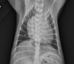 <p>left or right heart disease</p>
