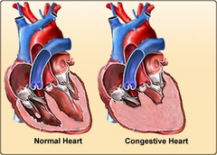<p>congestive heart failure</p>