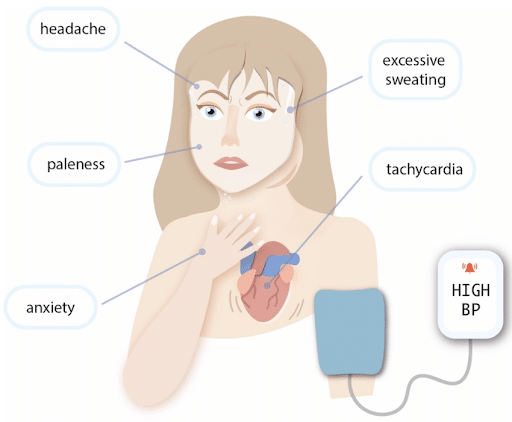 <p>A <strong>rare tumor of the adrenal gland</strong> that causes <strong>excess production of hormones (like adrenaline)</strong>, leading to <strong>high blood pressure and other symptoms</strong>.</p>