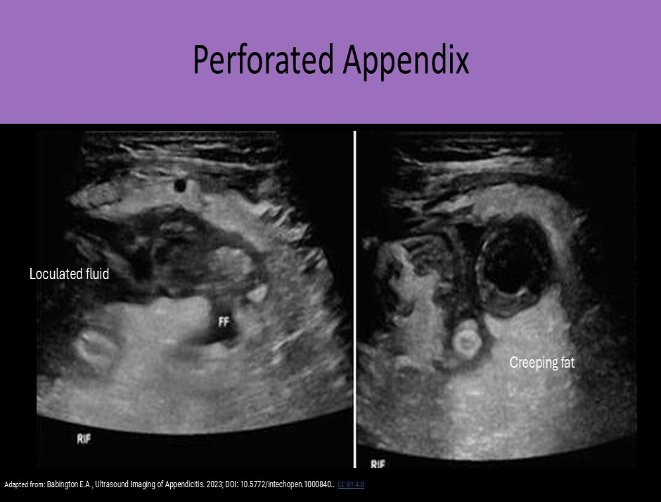 <p>B. appendiceal perforation</p><p>Appendiceal perforation is associated with loculated pericecal fluid, phlegmon formation, abscess formation, and prominent inflamed pericecal fat.</p><p class="p1">Pancreatitis can be associated with similar findings of phlegmon, abscess, loculated fluid, but not normally found in the area of the cecum.</p>