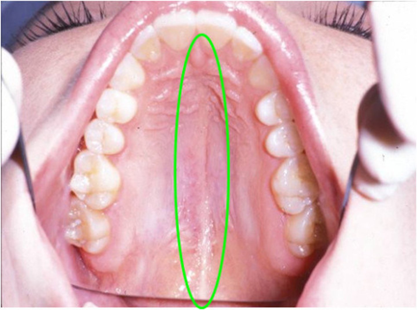<p>A seam of fibrous tissue.</p>