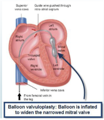 <p><span style="background-color: transparent;"><strong><u>Balloon Valvuloplasty</u></strong></span></p><ul><li><p><span style="background-color: transparent;">Commonly for _____</span></p></li><li><p><span style="background-color: transparent;">Requires <strong>pre-procedureal </strong>_____<strong> to rule out thrombus formation</strong></span></p></li><li><p><span style="background-color: transparent;">Possibly for <strong>aortic stenosis if pt is too high-risk for cardiac surgery</strong></span></p></li></ul><p></p>
