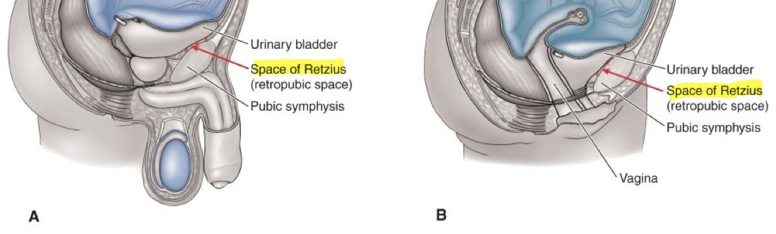 <p>Extra peritoneal space located between anterior wall of urinary bladder and pubic symphysis. </p><p>Pathologies, traumatic fluids, or surgical implants could be in this area</p>