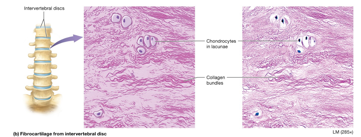 <p>ECM is filled with bundles of collagen and some elastic fibers made by fibroblasts</p><p>Found in fibrous joints including the intervertebral discs and articular discs that improve the fit of 2 bones</p><p>Lacks a perichondrium</p>