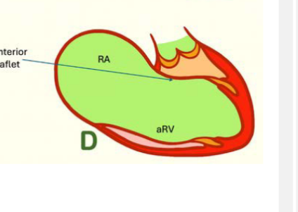 <ol><li><p>Extensive (tricuspid valve sac)</p></li><li><p>Complete failure of tricuspid leaflet delamination</p></li><li><p>Almost complete "atrialization" of the right ventricle with the exception of a small insufficient infundibular component</p></li></ol><p></p><p><strong>Complete non-delamination</strong> means the valve leaflets <strong>did not separate/free themselves from the inside wall of the RV at all</strong> during development.</p><p>Type D = the TV is basically stuck down into the RV like a sac, so almost the whole RV acts like atrium instead of a pumping ventricle.</p><p><strong>Atrialized RV = upper RV, acts like atrium/reservoir, poor contraction.</strong><br><strong>Functional RV = lower RV, still acts like ventricle, pumps to lungs.</strong></p><p>The more atrialized RV there is, the <strong>smaller the functional RV becomes</strong>, so the patient can have worse right-sided heart function.</p>
