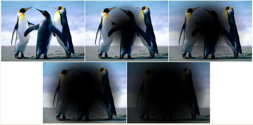 <p>macular degeneration </p>