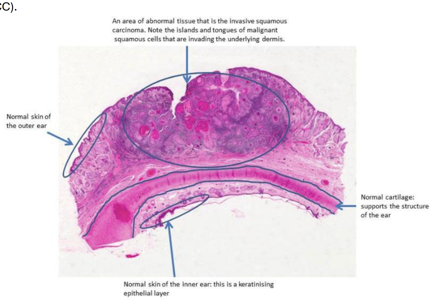 <p>Islands of tumour cells are infiltrating through the dermis of this skin specimen. Many of these islands show central areas of keratin deposition (in H&amp;E preparations this shows up as a bright pink protein). </p>