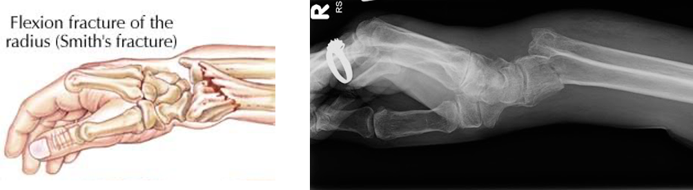 <ul><li><p>Falls inward</p><ul><li><p>Force generated <strong>dorsally/posteriorly</strong>: bone shifted that way</p></li></ul></li></ul><p></p><img src="https://assets.knowt.com/user-attachments/c964ef83-bad4-4b13-ae46-5e26457e6e19.png" data-width="100%" data-align="center"><p></p>