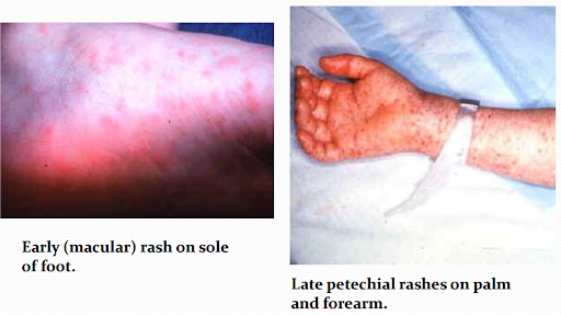 <p>RMSF (Rickettsia rickettsiae - rocky mountain spotted fever)) presentation - initial s/sx</p>