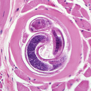 <ul><li><p>infection of muscle tissue with larvae</p></li><li><p>how it migrates to muscle tissue:</p><ul><li><p>human eats undercooked meat</p></li><li><p>adult lives in the intestine and gives birth to larvae</p></li><li><p>larvae penetrate the intestinal wall and enter circulation</p></li><li><p>larvae are deposited in striated muscle where they coil and become encapsulated</p></li></ul></li></ul><p></p>