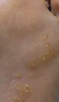 <p>these papules on palms and soles, typically appearing during adolescence or adulthood</p>