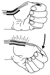 <p>special test for de Quervain's tenosynovitis</p>