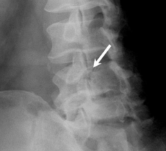 <p>No definitive gold standard (ombination of X-rays, CT scan, SPECT scan)</p><p>X-ray: AP/Lateral/Oblique</p><p> - Scottie Dog on oblique X-ray</p>