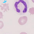 <p>any deviation from discocyte (leftovers)</p>