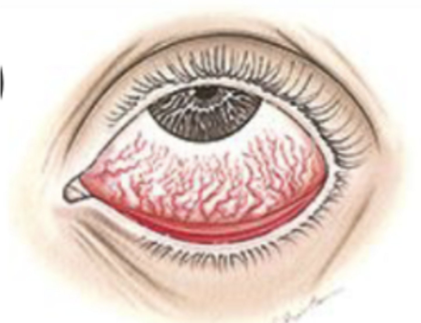 <p>- diffuse dilatation of conjunctival vessels with redness that tends to be maximal peripherally</p><p>- Watery, mucoid, or mucopurulent</p><p>- Mild discomfort rather than pain</p><p>- Not affected except for temporary mild blurring due to discharge</p><p>Significance: Bacterial, viral, and other infections; highly contagious; allergy; irritation</p>