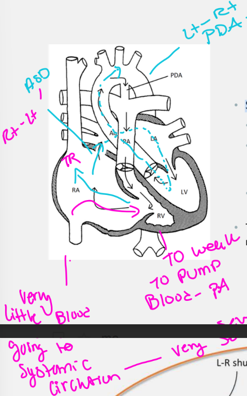 <p>Severe Ebstein’s demonstrates circular shunt physiology (D-TGA)</p>