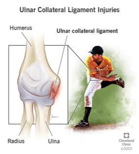 <ul><li><p><span>Repetitive forceful elongation of the UCL may lead to plastic deformation</span></p></li><li><p><span>Instability and loss of velocity for throwing athletes</span></p></li></ul><p></p>