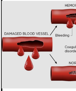 <p><span style="background-color: transparent;">hemophilia</span></p>
